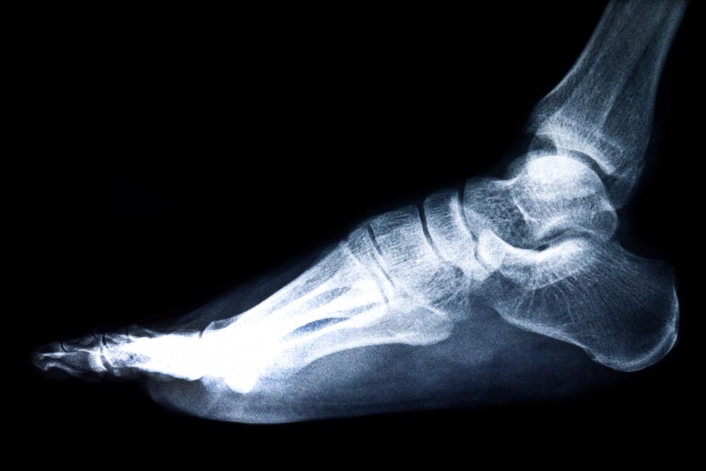 Types of Ankle Fractures